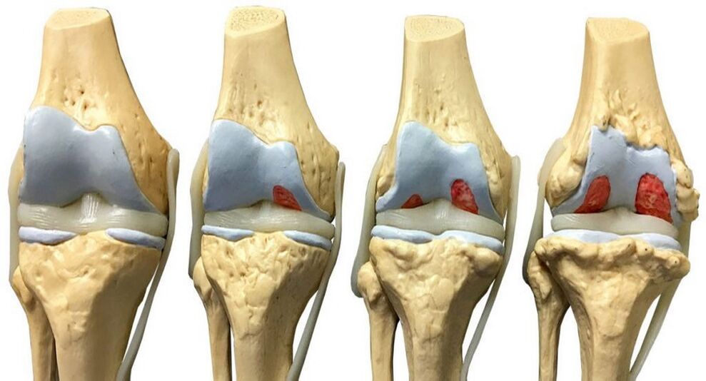 Arthrose mit Hondrofrost behandelt werden