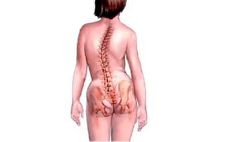 Gründe für die Entwicklung einer zervikalen Osteochondrose