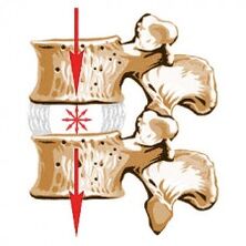 Das Gerät der Wirbelsäule und die Ursachen der Osteochondrose
