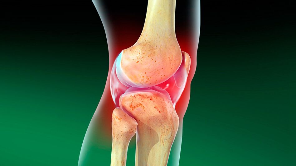 Arthrose des Kniegelenks
