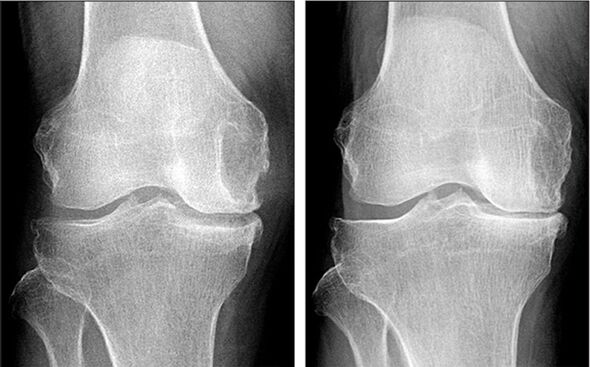 vor und nach Arthrosebehandlung mit Hondrofrost